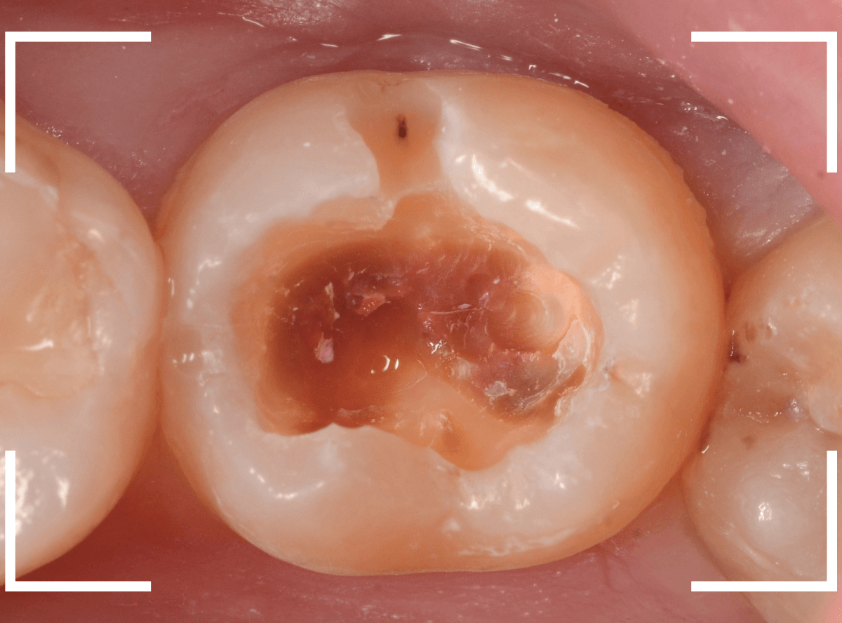 レントゲンでわかりづらい虫歯17-5