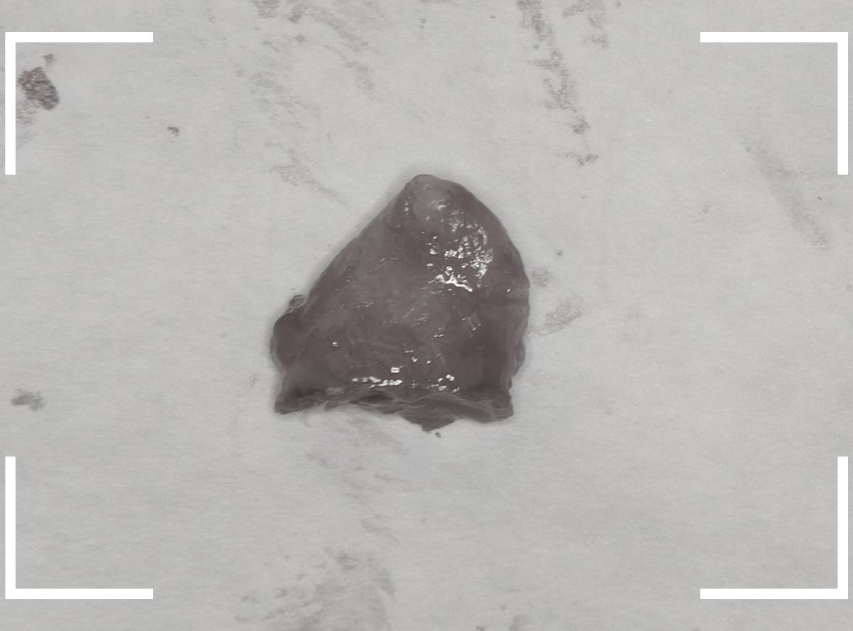 虫歯を放置して、抜歯7-5