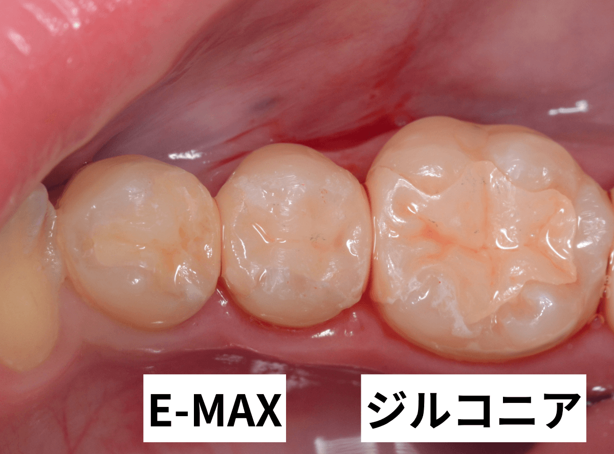 セラミック治療(インレー)4-3
