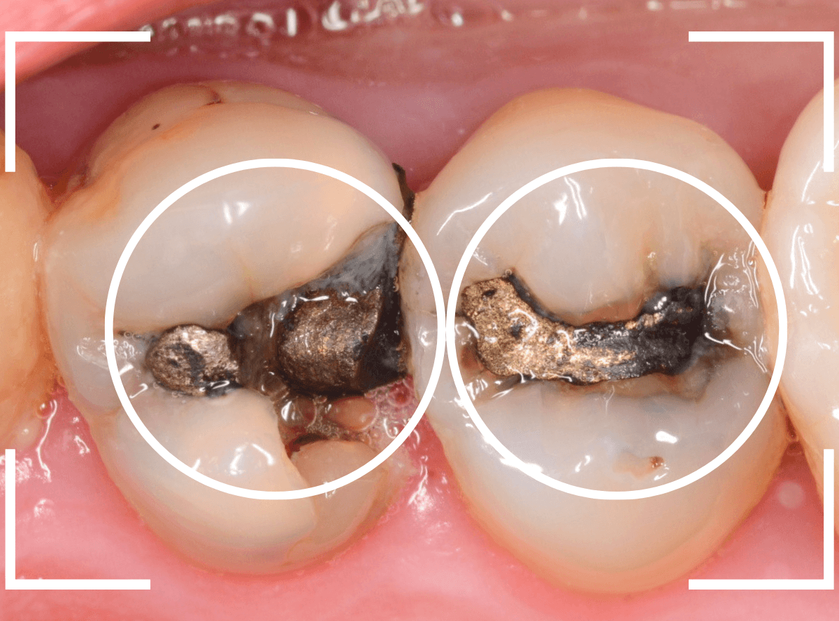 つめものの下の深い虫歯(画像)10-1