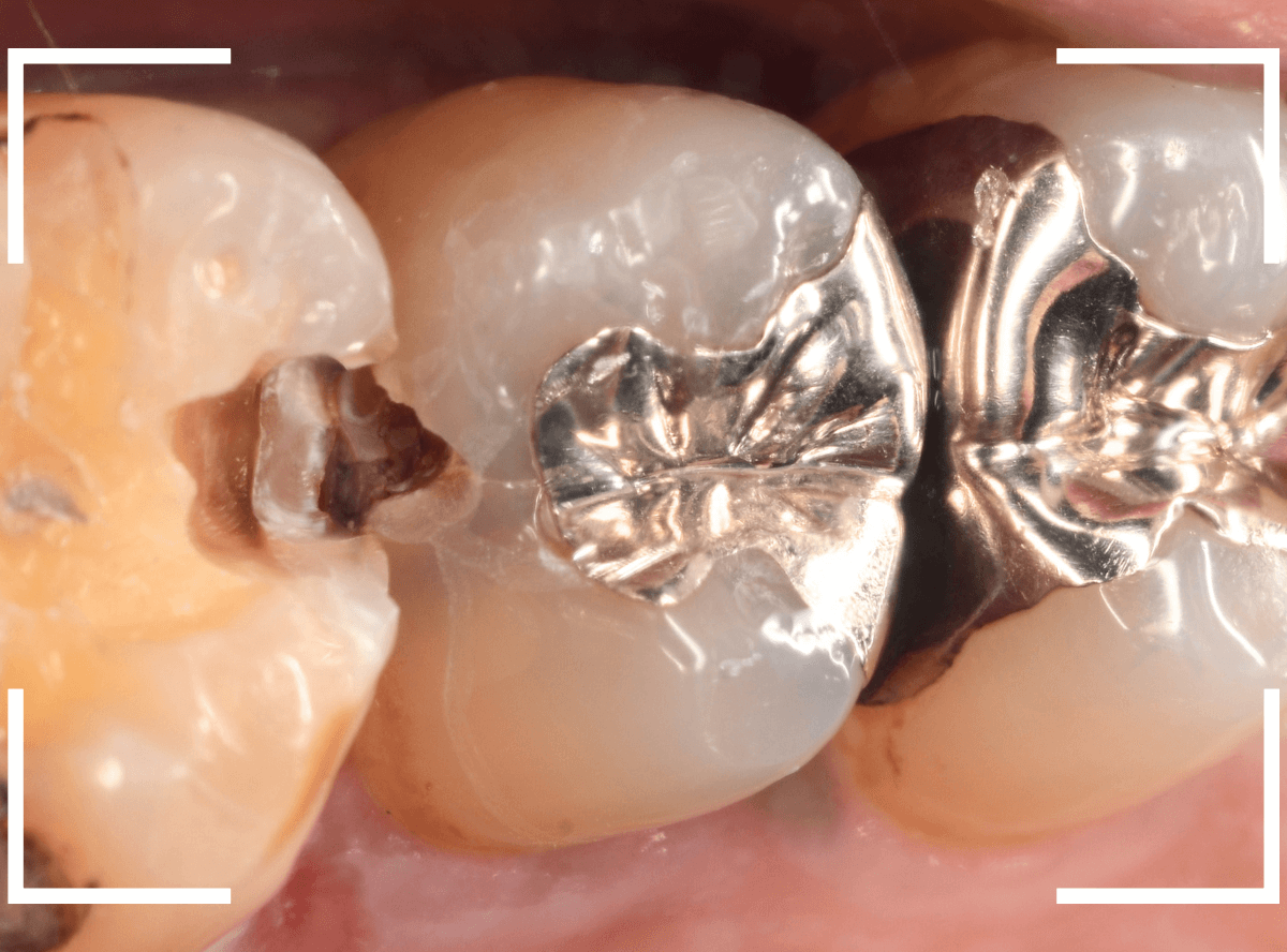 歯と歯の間の虫歯25-5