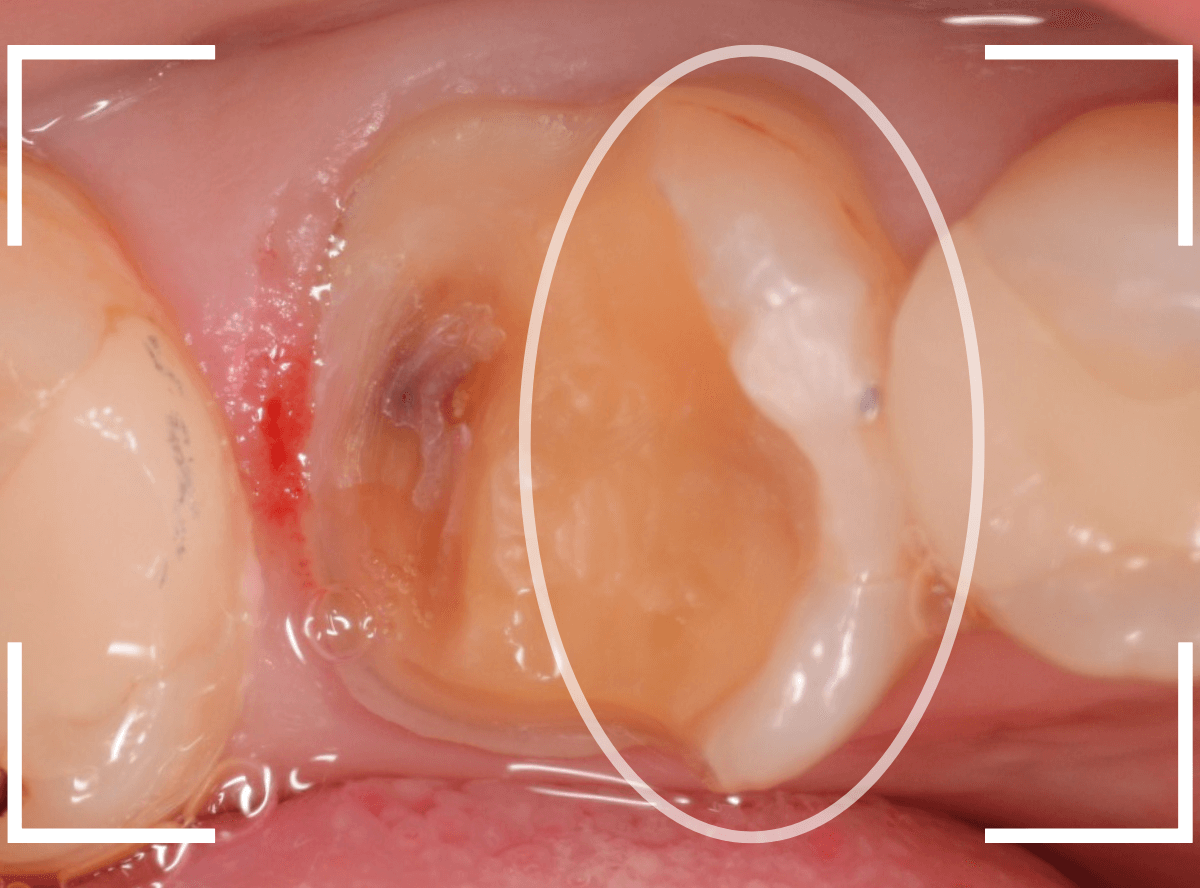 セラミック治療(クラウン・奥歯)7-3