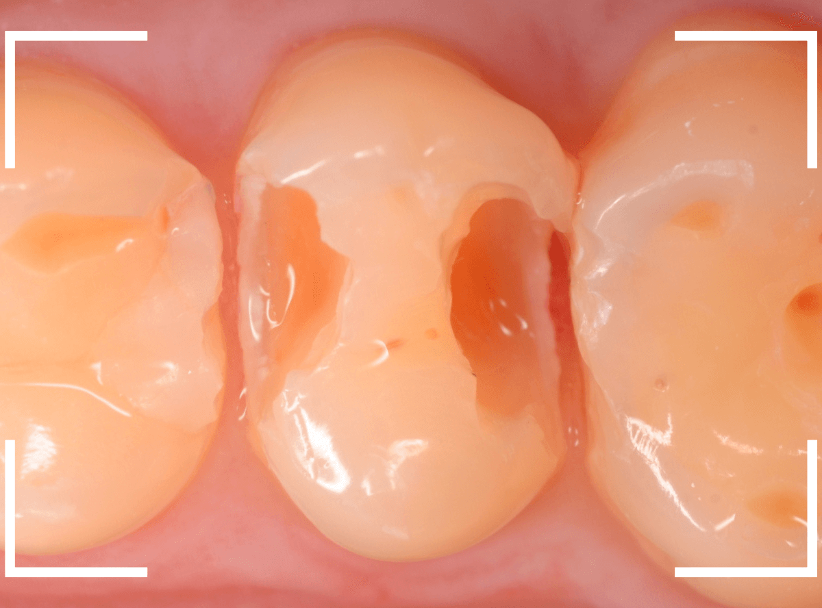 セラミック治療(インレー)24-7