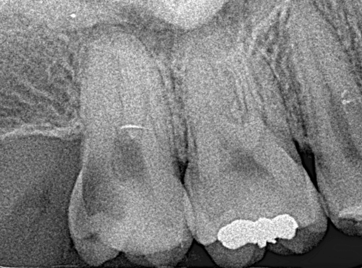 気づかないうちに深い虫歯1-2