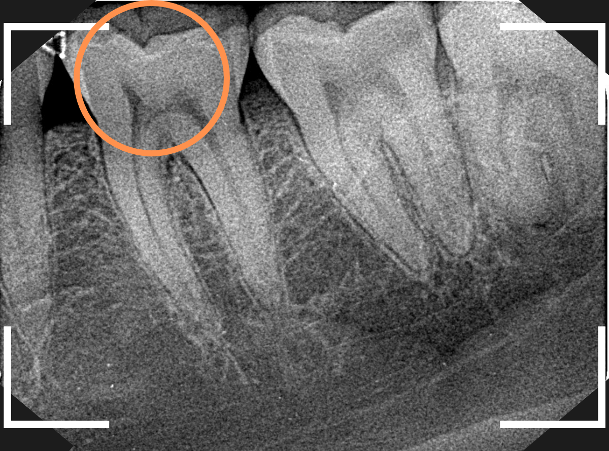 知覚過敏の画像4-3