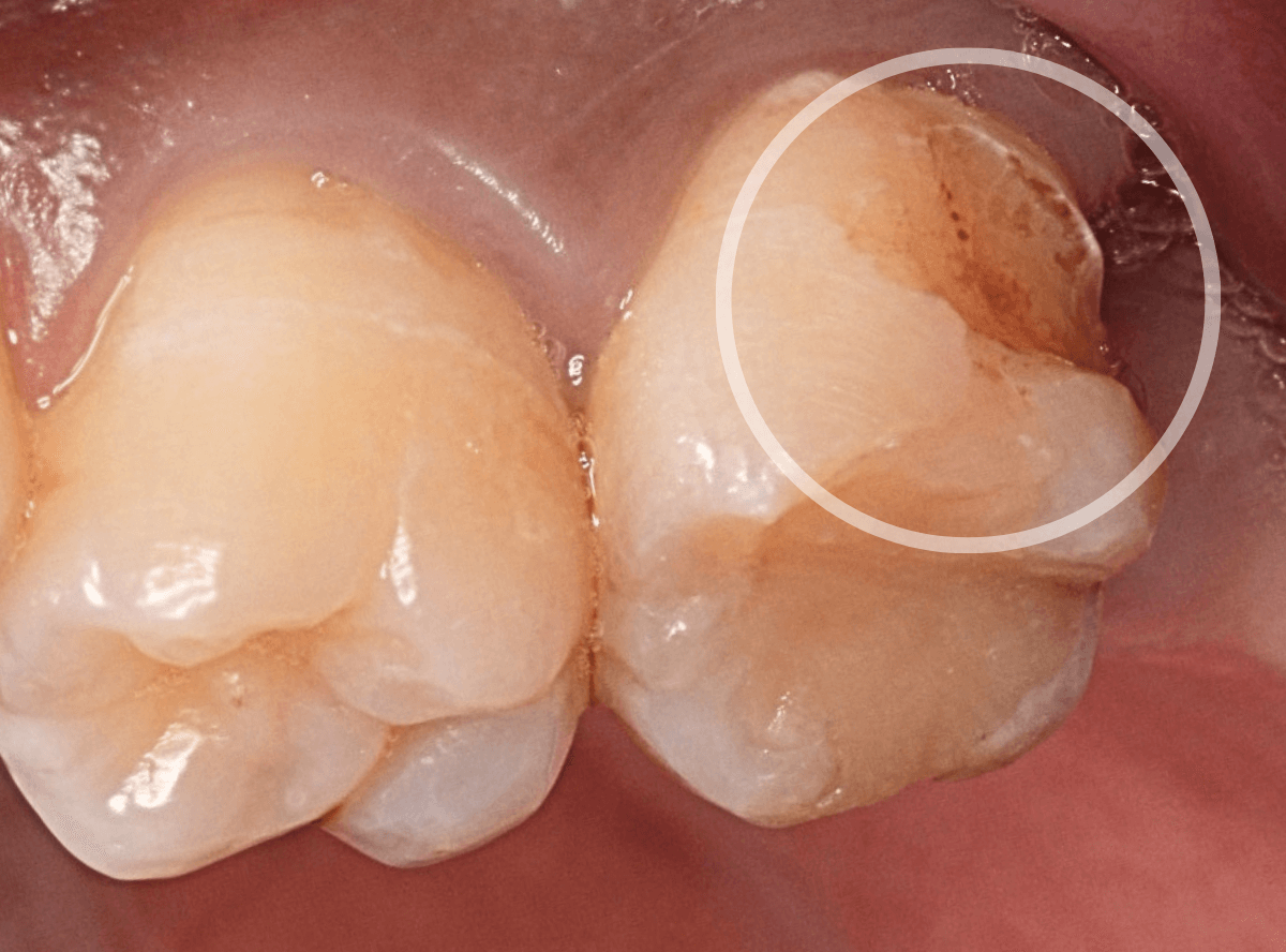 知覚過敏の画像2-1