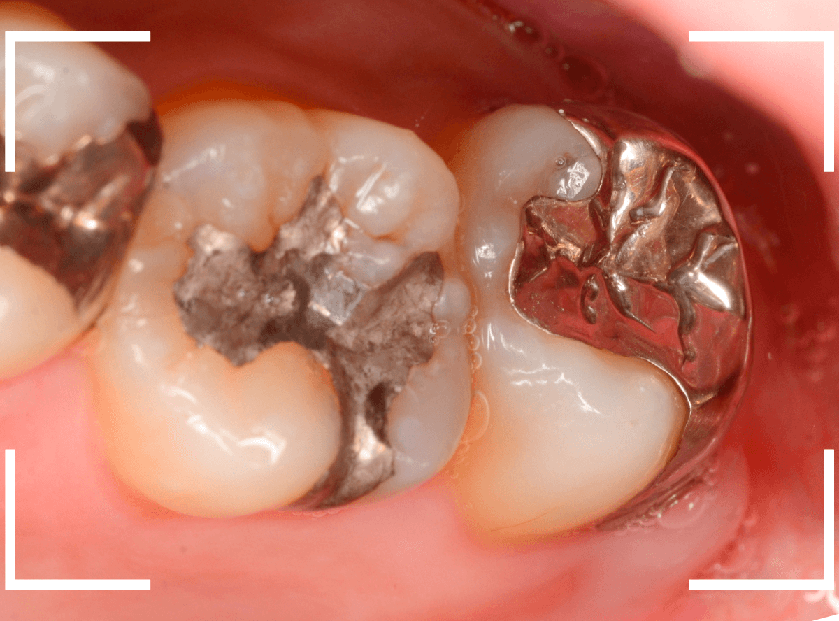 つめものの下の深い虫歯(画像)10-1