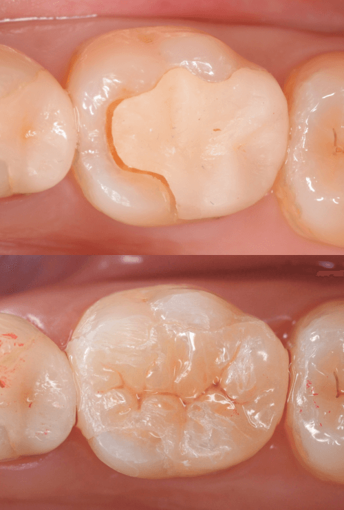 セラミック治療(インレー)12-5