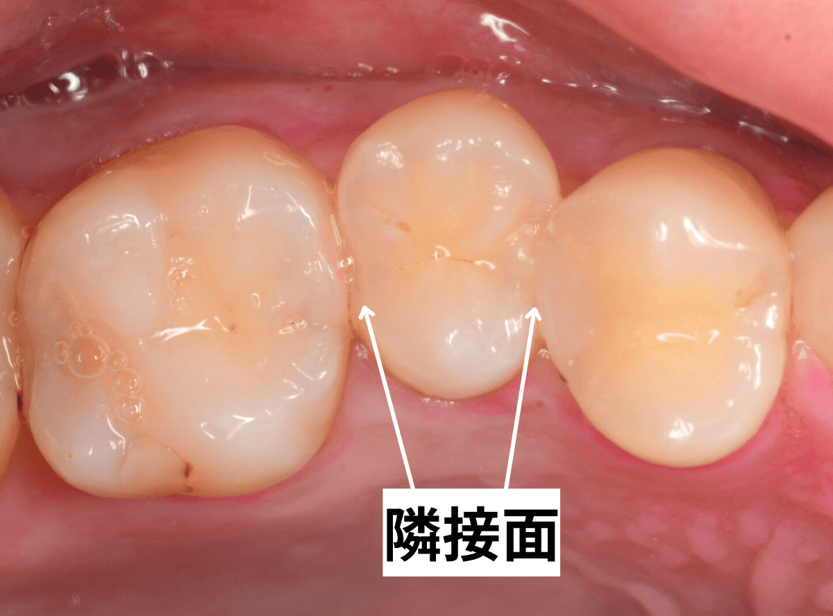 隣接面う蝕