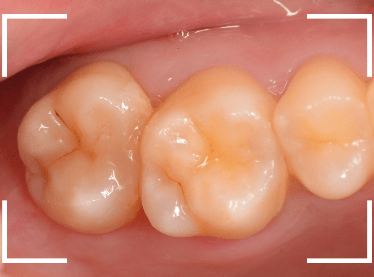 歯と歯の間の虫歯20-1