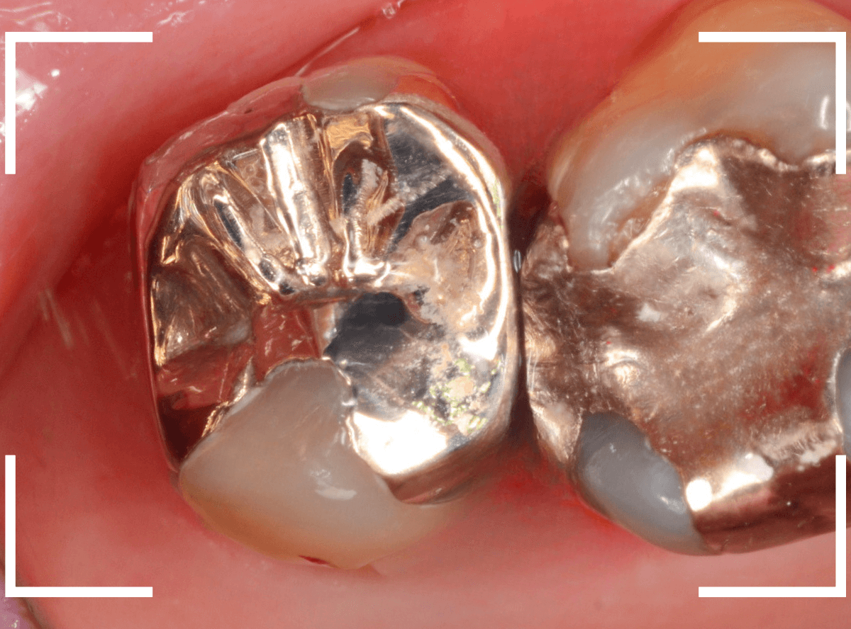 つめものの下の深い虫歯(画像)10-1