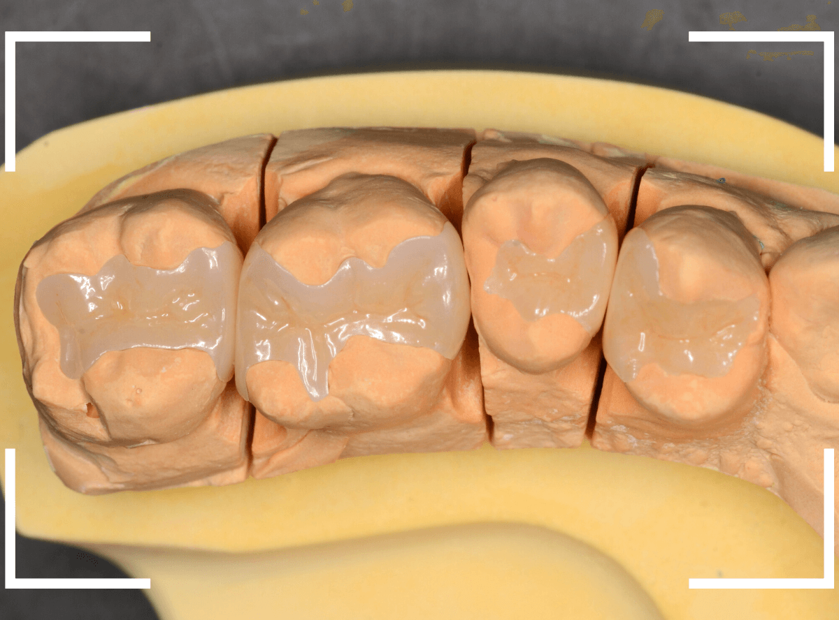 セラミック治療(インレー)34-4