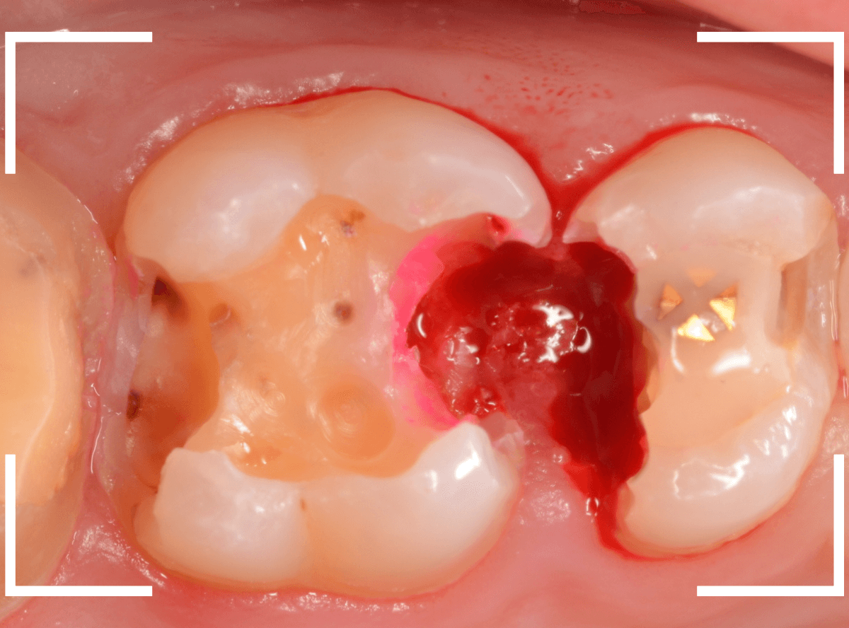 気づかないうちに深い虫歯7-4