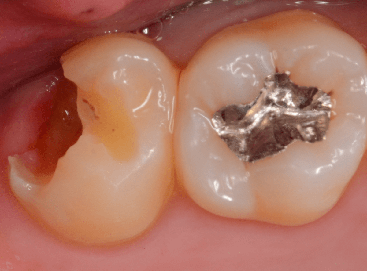 気づかないうちに深い虫歯1-6
