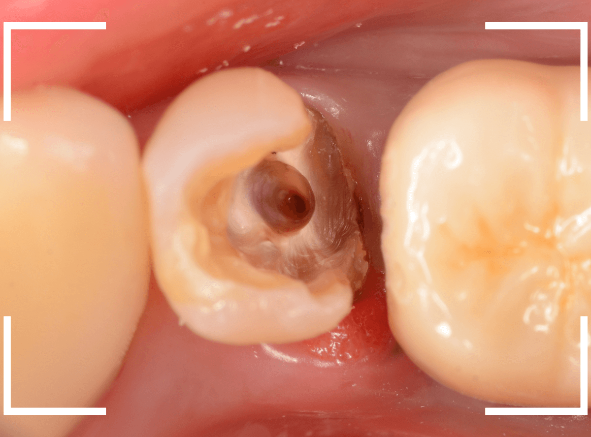 セラミック治療(クラウン・奥歯)8-2