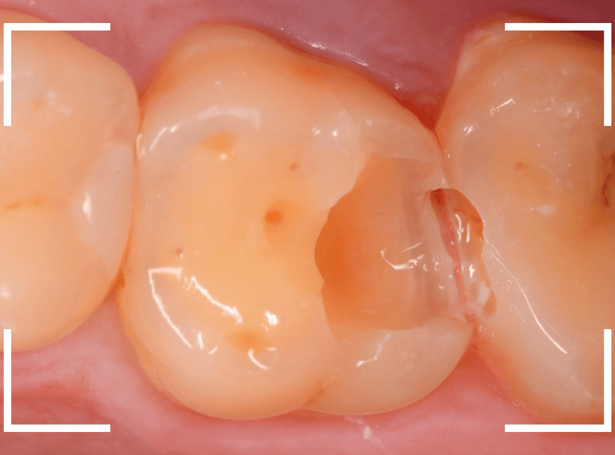 セラミック治療(インレー)24-5