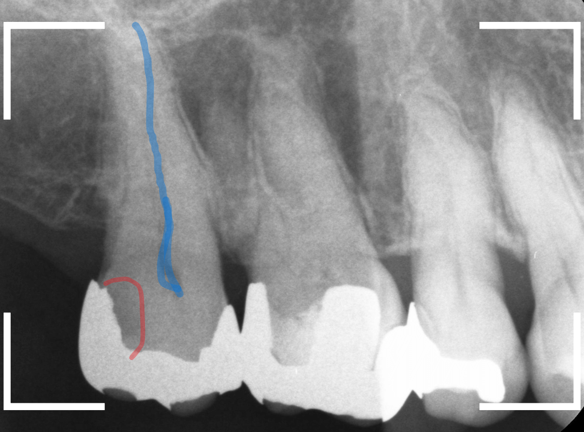 つめものの下の深い虫歯(画像)10-1