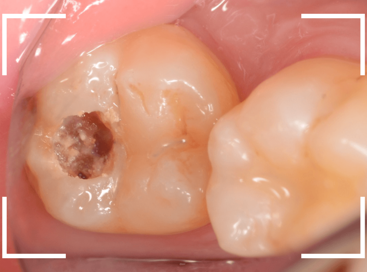 つめものの下の深い深い虫歯19-4