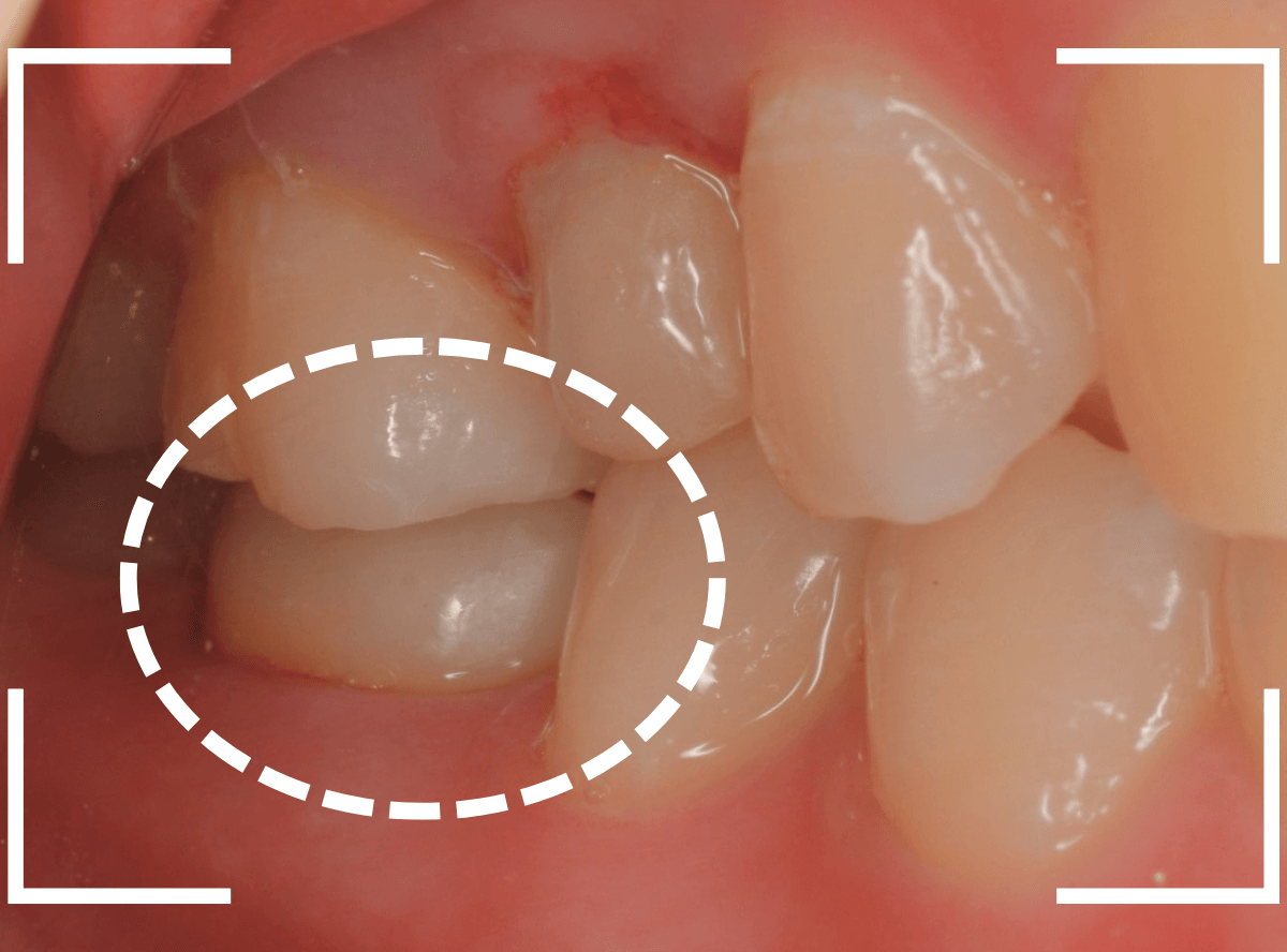 セラミック治療(クラウン・奥歯)15-5
