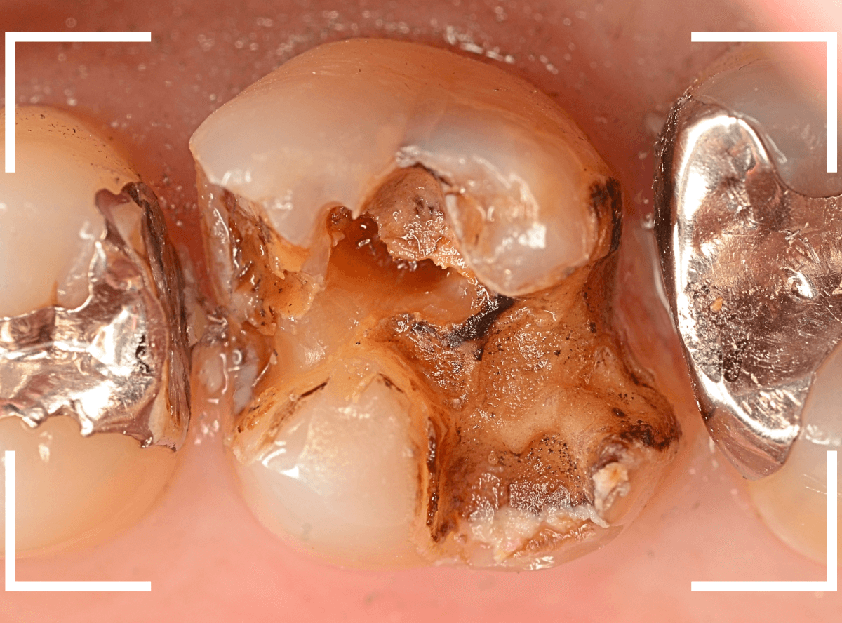 つめものの下の深い虫歯(画像)10-1