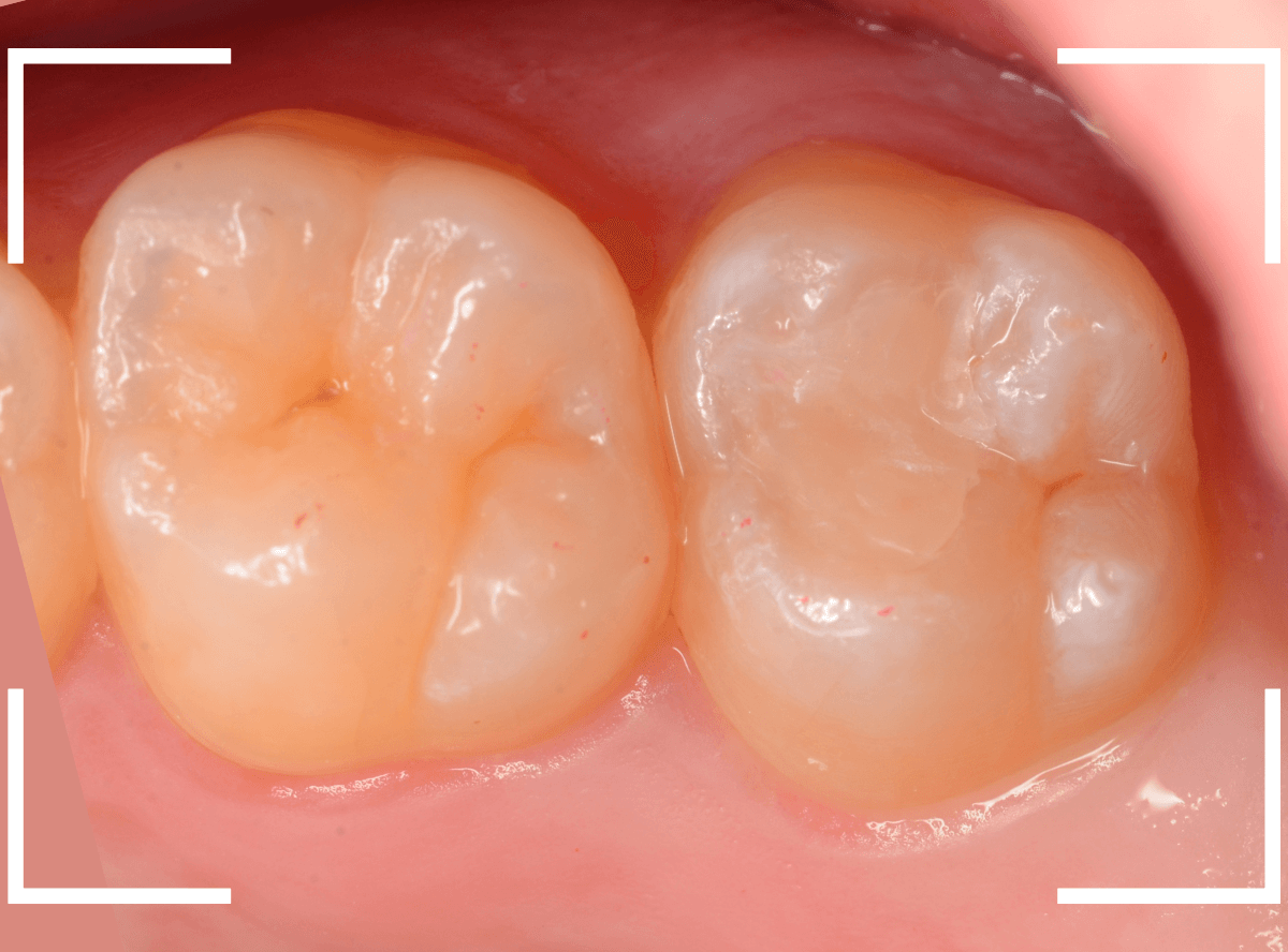 小窩裂溝う蝕4-5