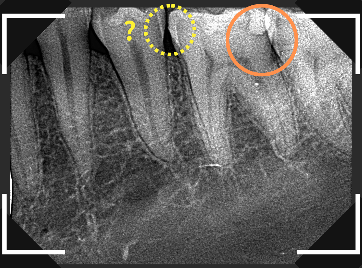 レントゲンでわかりづらい虫歯6-2