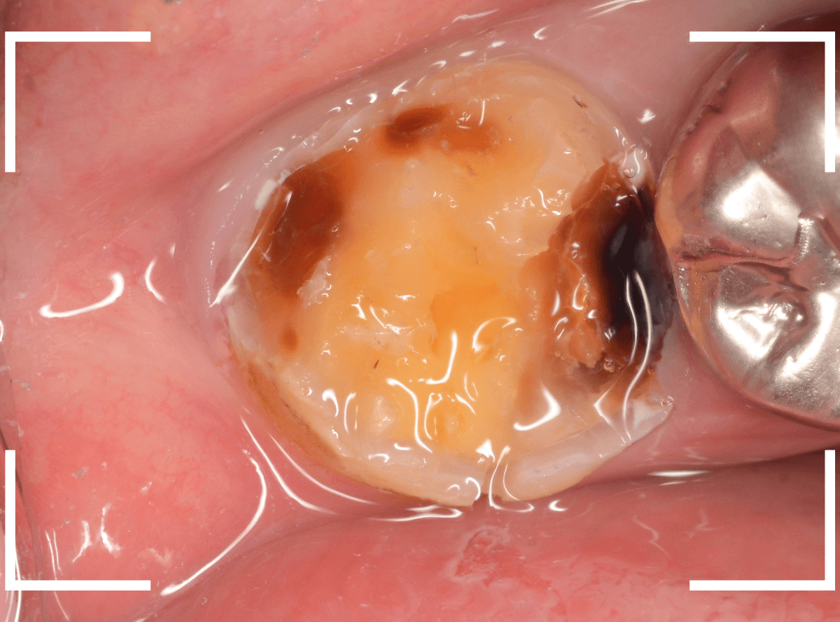 気づかないうちに深い虫歯14-4
