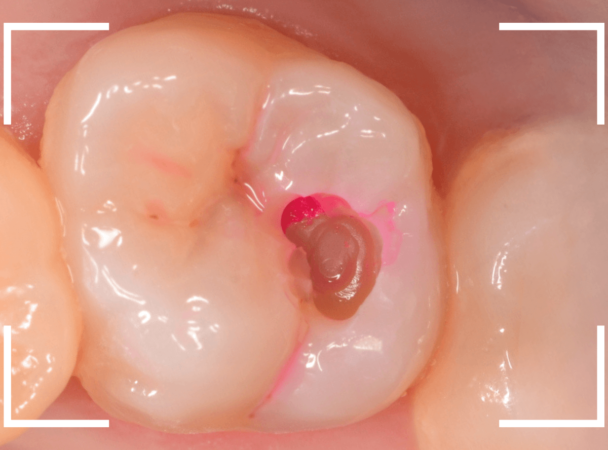 つめものの下の深い深い虫歯20-1