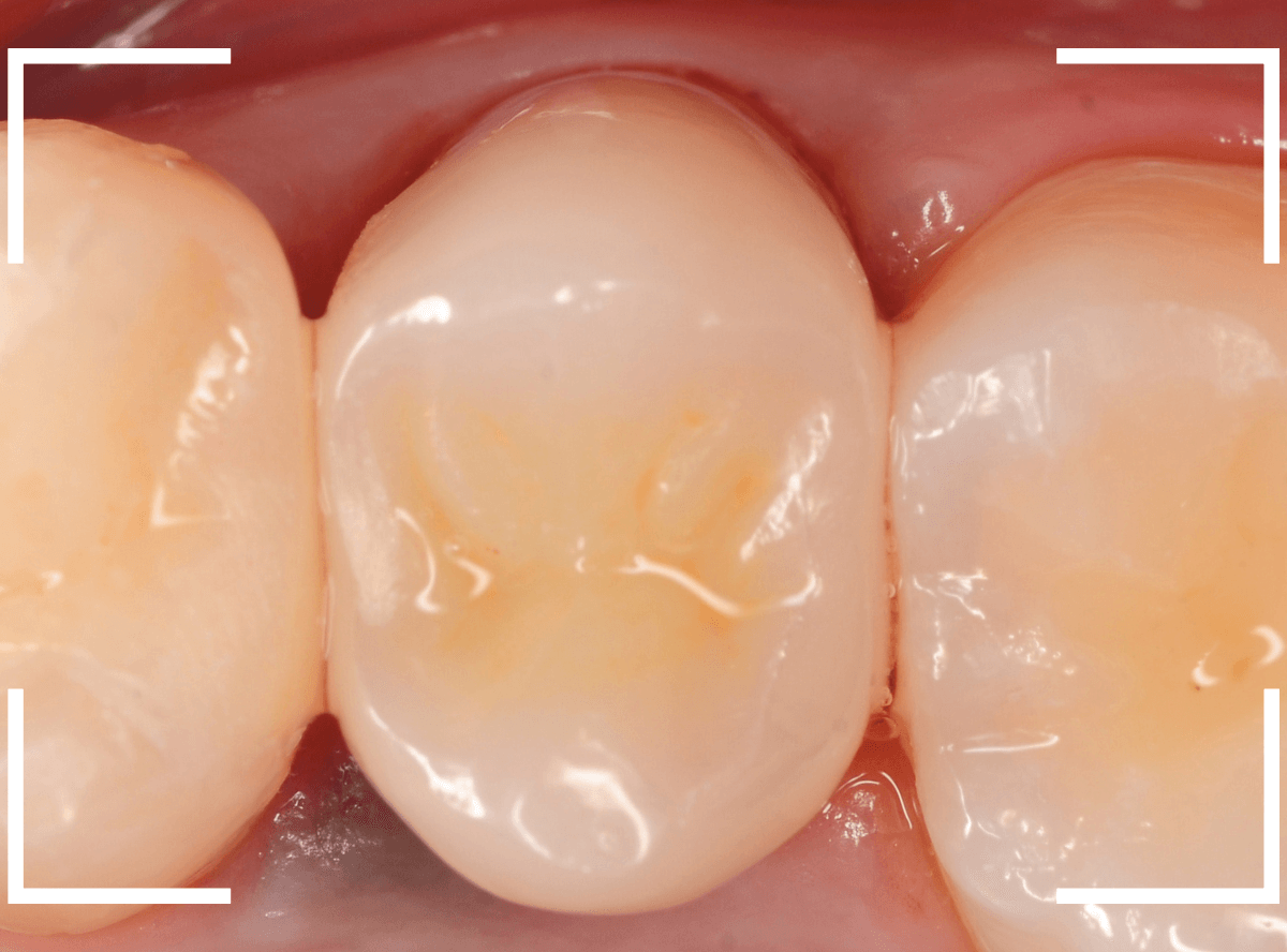 セラミック治療(クラウン・奥歯)9-9