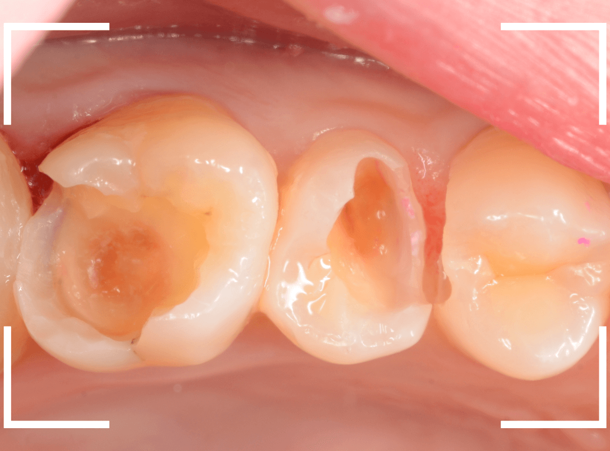 セラミック治療(インレー)32-9