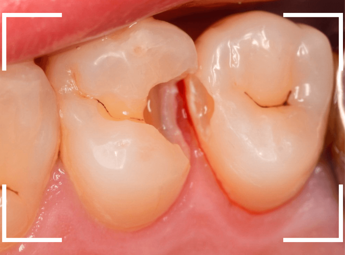 つめものの下の深い深い虫歯18-5