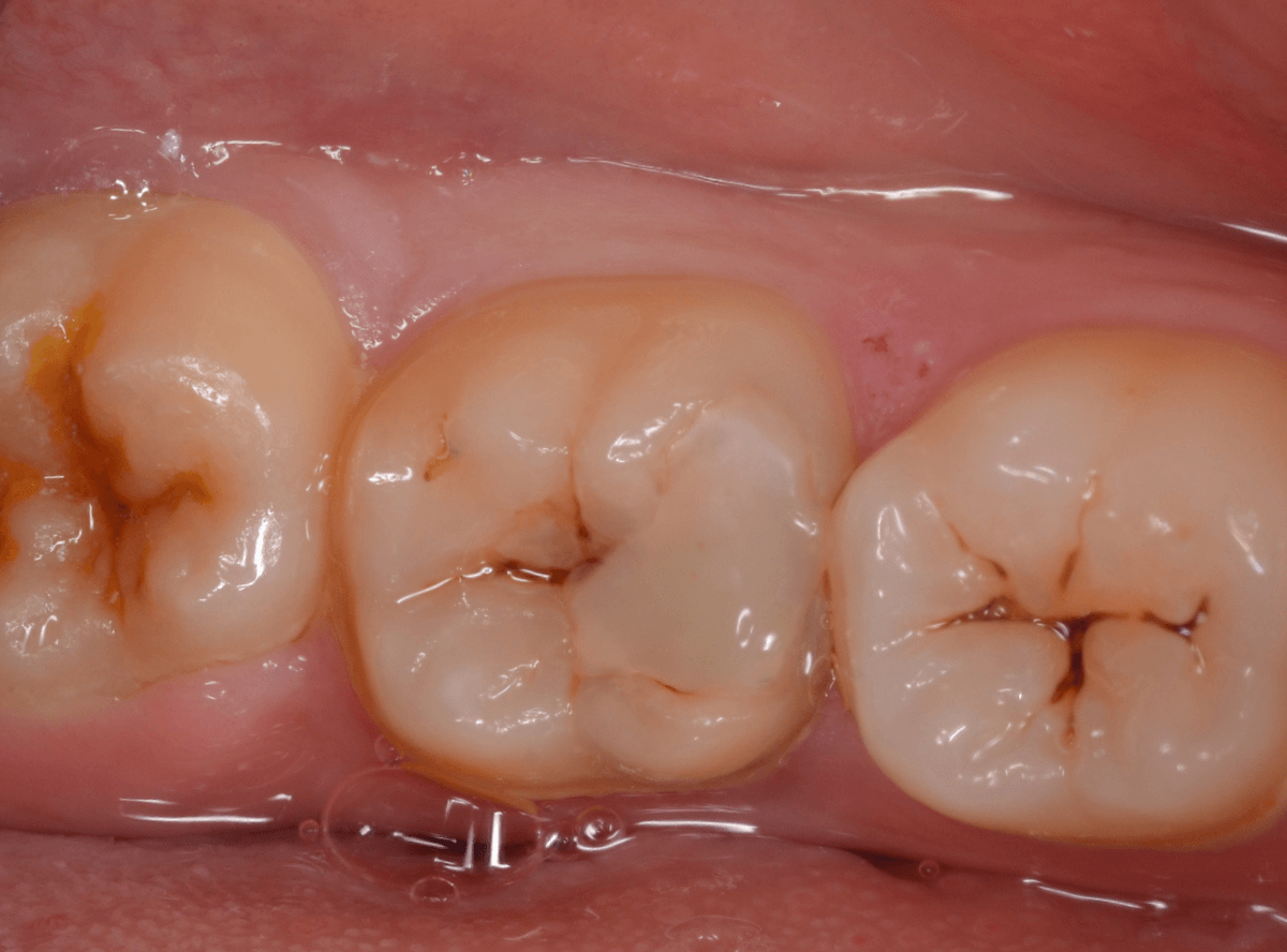 つめものの下の深い深い虫歯11-1