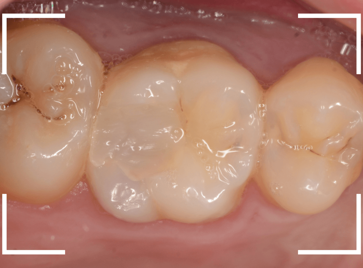 つめものの下の深い深い虫歯20-1