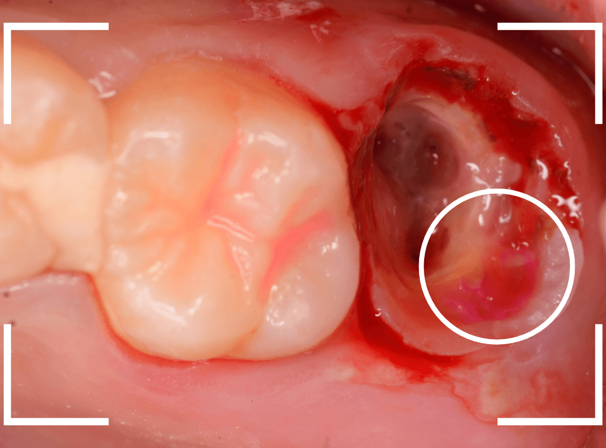 セラミック治療(クラウン・奥歯)10-2