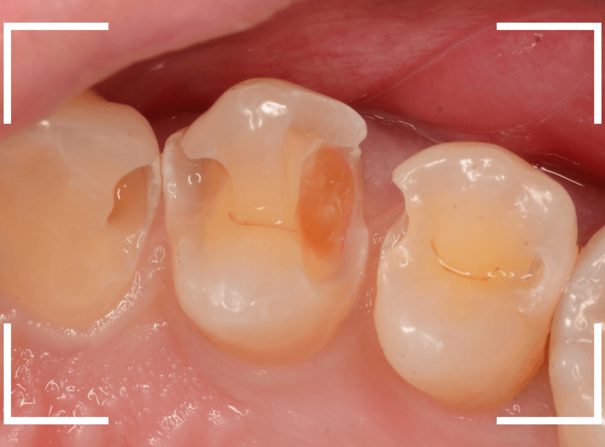 歯と歯の間の虫歯16-7