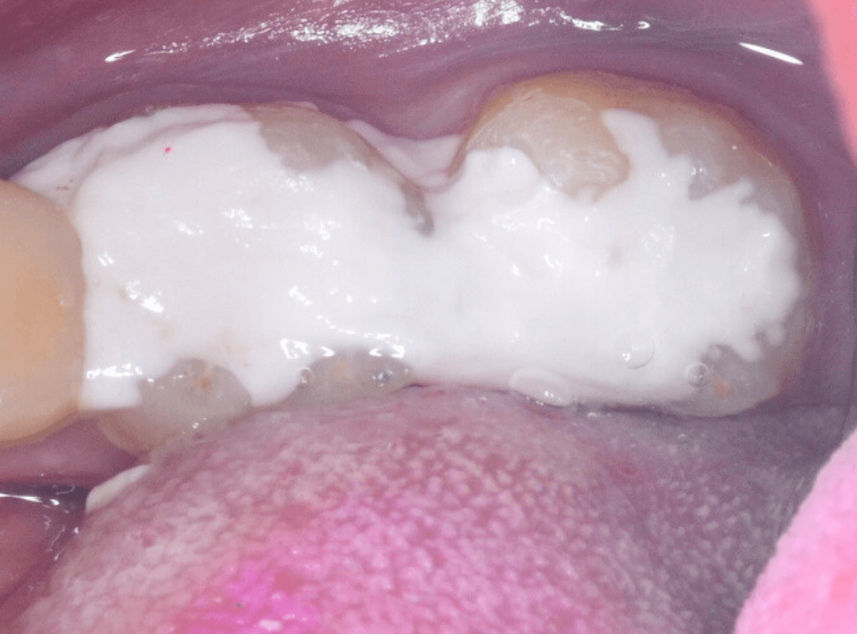 つめものの下の深い虫歯(画像)1-6