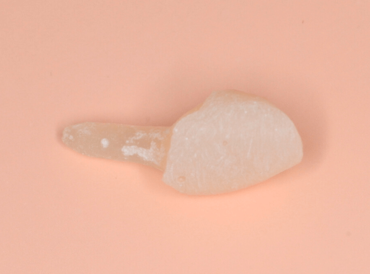 「前歯が折れた」という患者さん-4