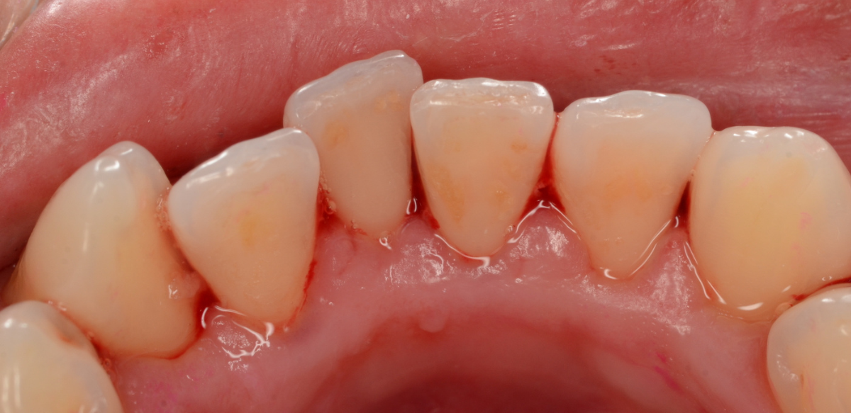 歯肉の中の歯石（歯肉縁下歯石）除去(画像）4-4