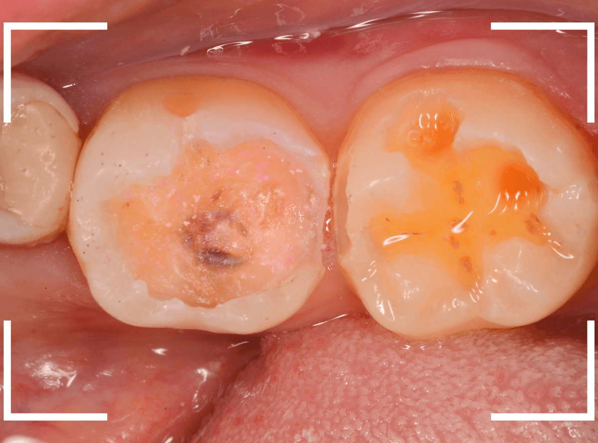 小窩裂溝う蝕2-6