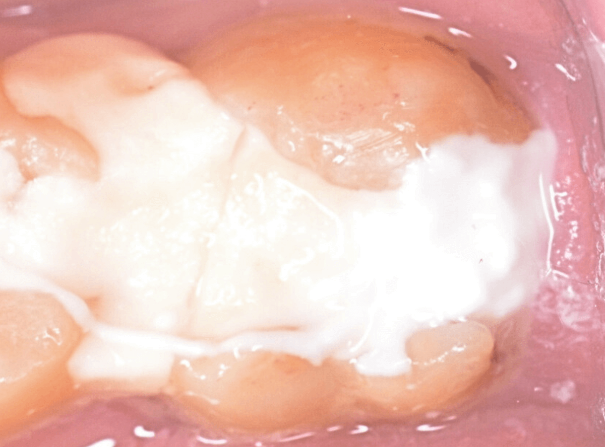 つめものの下の深い深い虫歯2-7