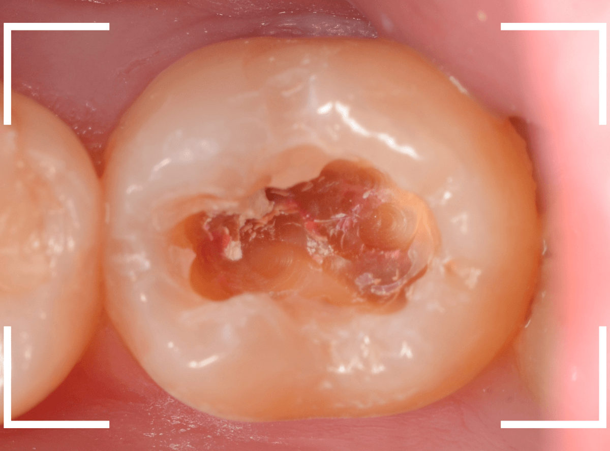 レントゲンでわかりづらい虫歯17-4