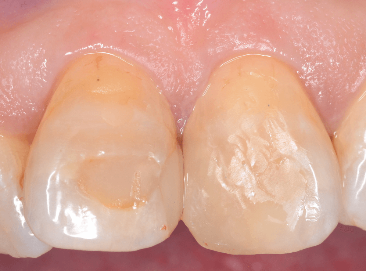 コンポジットレジン治療3-5