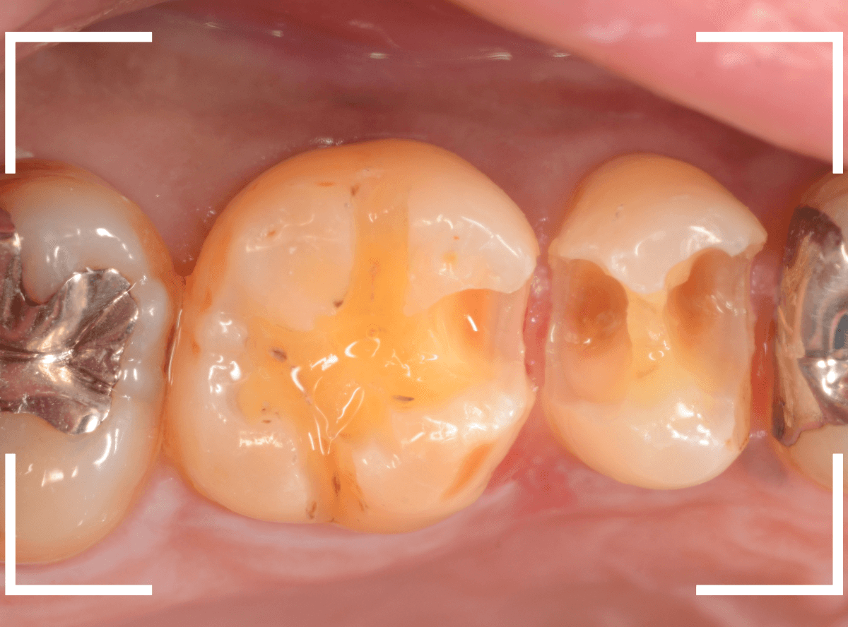 歯と歯の間の虫歯25-7