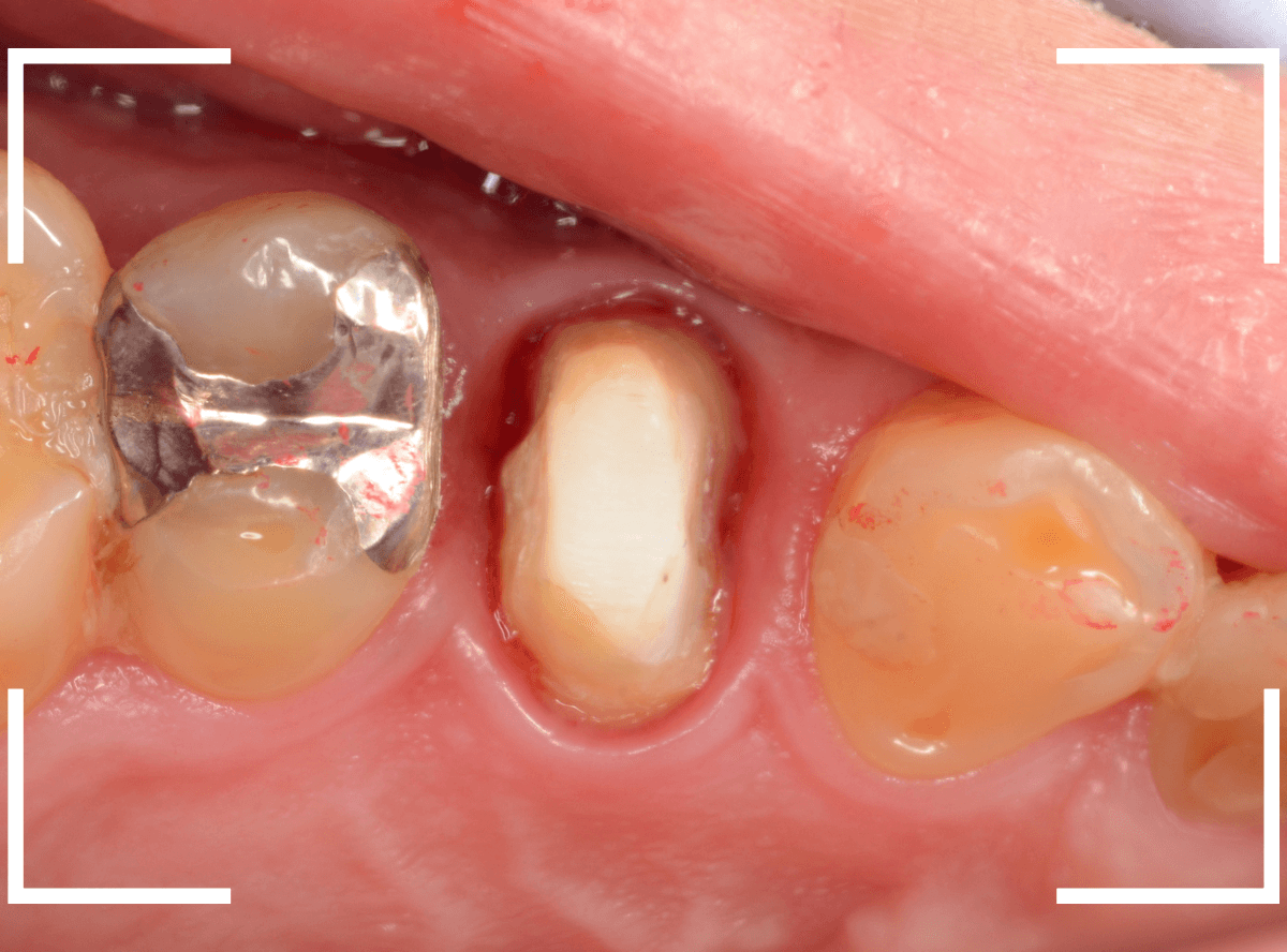 セラミック治療(クラウン・奥歯)14-1