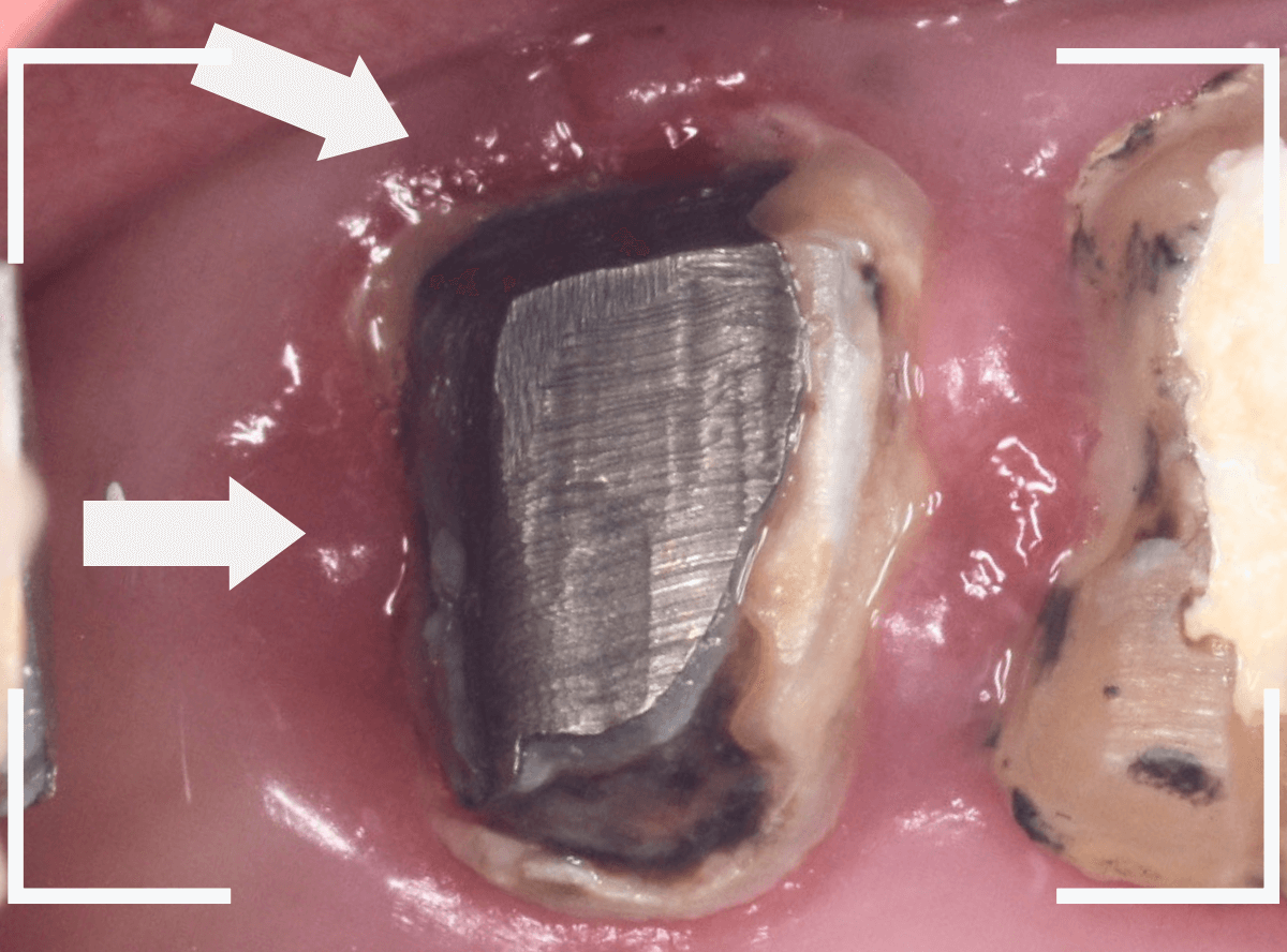 歯の土台の再治療2-1