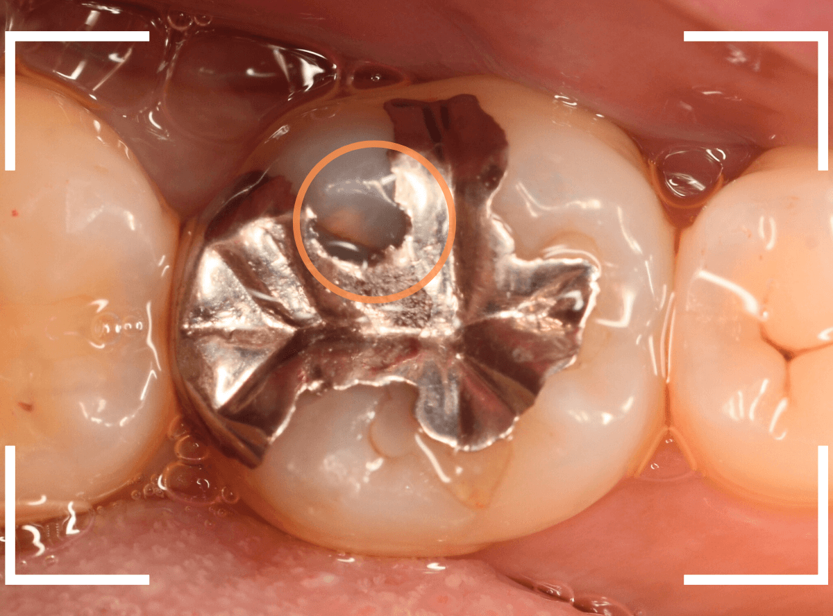 つめものの下の深い虫歯(画像)10-1