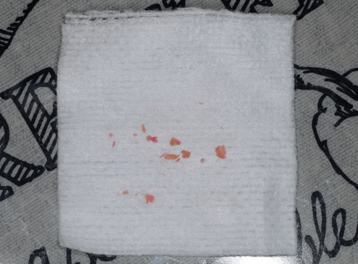 つめものの下の深い深い虫歯11-1