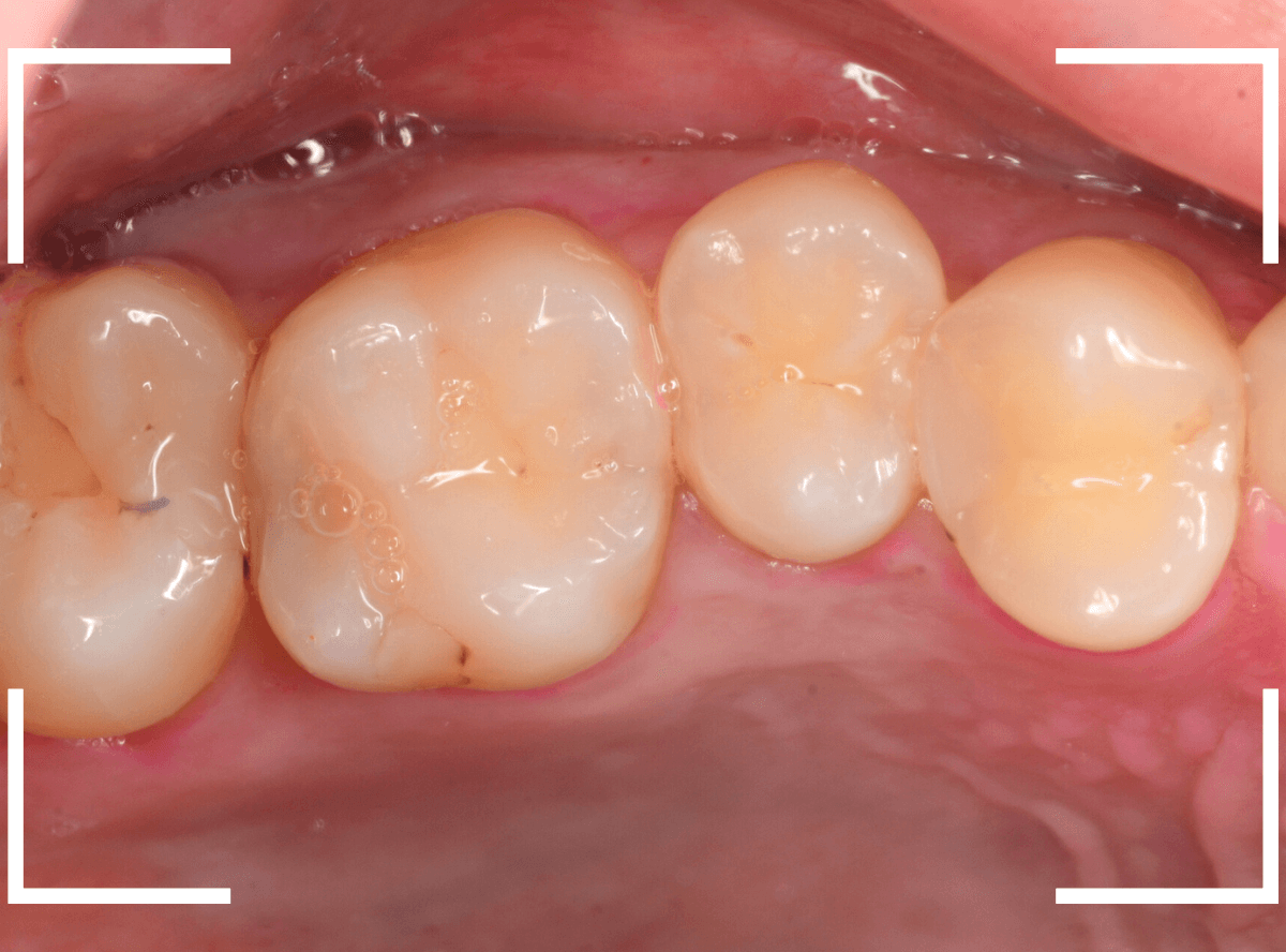 歯と歯の間の虫歯17-1