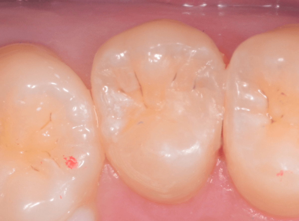 レントゲンでわかりづらい虫歯2-6