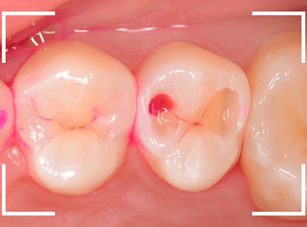 歯と歯の間の虫歯15-3